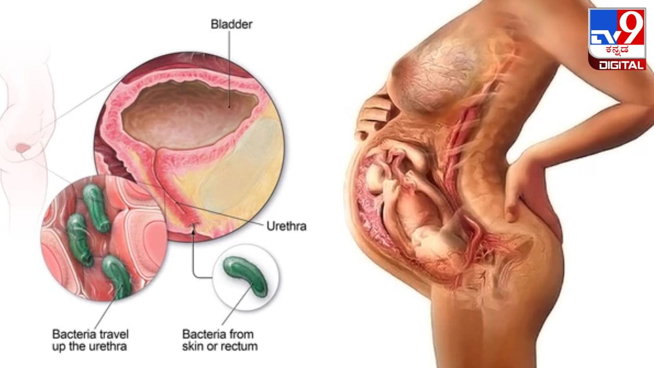 Infertility: ಮೂತ್ರನಾಳದ ಸೋಂಕು ಮಹಿಳೆಯರಲ್ಲಿ ಬಂಜೆತನಕ್ಕೆ ಕಾರಣವಾಗಬಹುದು