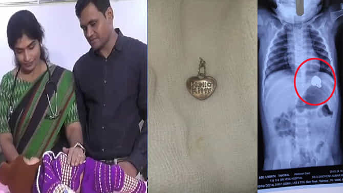 ಲಾಕೆಟ್ ನುಂಗಿದ 6 ತಿಂಗಳ ಮಗು.. ಆಮೇಲೆ ಅದನ್ನು ಹೊರತೆಗೆದಿದ್ದು ಹೇಗೆ