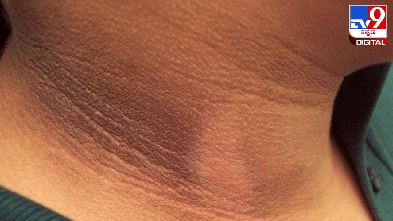 Dark Neck: ಕುತ್ತಿಗೆ ಭಾಗ ಕಪ್ಪಾಗಿದ್ದರೆ,ಈ ಸಿಂಪಲ್ ಮನೆಮದ್ದು ಟ್ರೈ ಮಾಡಿ Dark Neck: ಕುತ್ತಿಗೆ ಭಾಗ ಕಪ್ಪಾಗಿದ್ದರೆ,ಈ ಸಿಂಪಲ್ ಮನೆಮದ್ದು ಟ್ರೈ ಮಾಡಿ