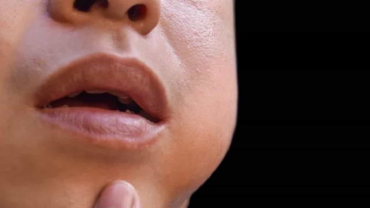 Mumps Symptoms: ಮಂಗನಬಾವು ಸೋಂಕಿಗೆ ಕಾರಣವೇನು?; ಇದಕ್ಕೆ ಚಿಕಿತ್ಸೆ ಇದೆಯೇ? Mumps Symptoms: ಮಂಗನಬಾವು ಸೋಂಕಿಗೆ ಕಾರಣವೇನು?; ಇದಕ್ಕೆ ಚಿಕಿತ್ಸೆ ಇದೆಯೇ?