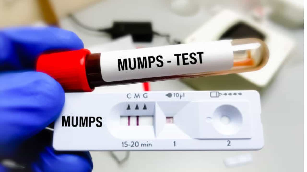 Mumps Virus: ಮಂಗನಬಾವು ಎಂದರೇನು?; ಈ ರೋಗ ಮಕ್ಕಳಿಗೆ ಅಪಾಯಕಾರಿಯೇ? Mumps Virus: ಮಂಗನಬಾವು ಎಂದರೇನು?; ಈ ರೋಗ ಮಕ್ಕಳಿಗೆ ಅಪಾಯಕಾರಿಯೇ?