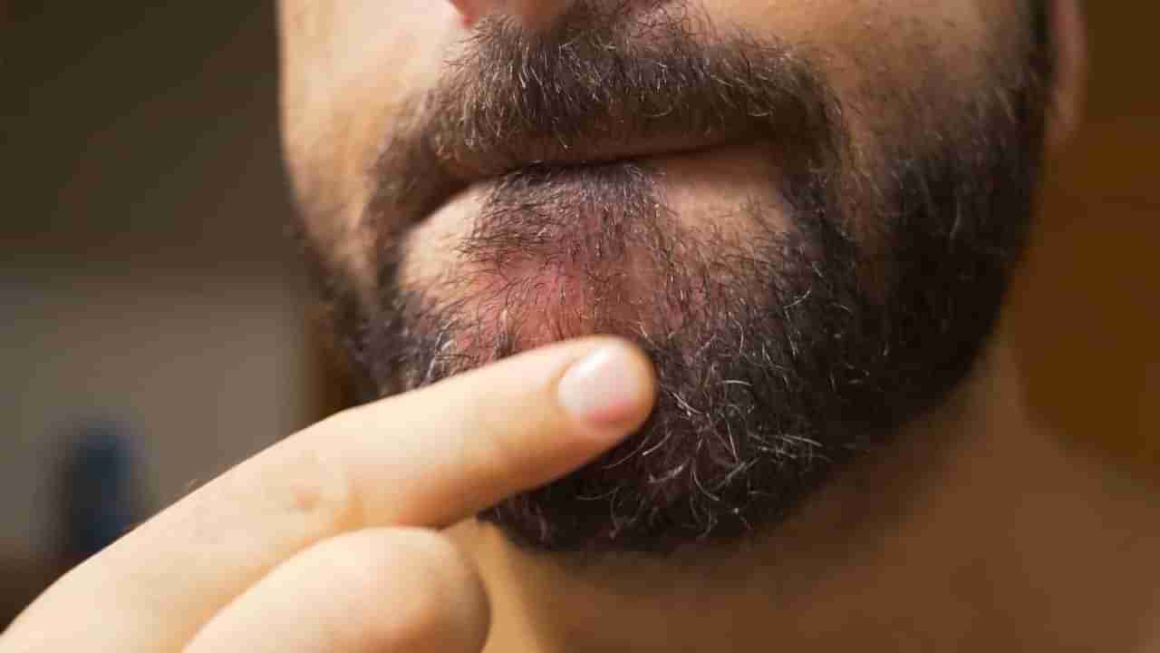 Beard Maintenance: ನಿಮ್ಮ ಗಡ್ಡ ತುರಿಕೆ ಮತ್ತು ಕಿರಿಕಿರಿಯನ್ನುಂಟುಮಾಡುತ್ತಿದೆಯೇ?