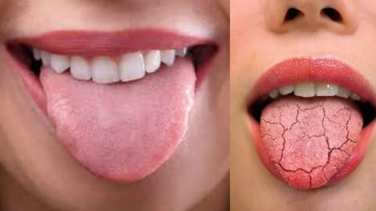 ನಿದ್ರಿಸುವಾಗ ನಿಮ್ಮ ಗಂಟಲು ಒಣಗುತ್ತಿದೆಯೇ? ಪಸೆ ಇಂಗುತ್ತಿದೆಯೇ? ಈ ರೋಗ ಲಕ್ಷಣ ಇರಬಹುದು ನಿದ್ರಿಸುವಾಗ ನಿಮ್ಮ ಗಂಟಲು ಒಣಗುತ್ತಿದೆಯೇ? ಪಸೆ ಇಂಗುತ್ತಿದೆಯೇ? ಈ ರೋಗ ಲಕ್ಷಣ ಇರಬಹುದು