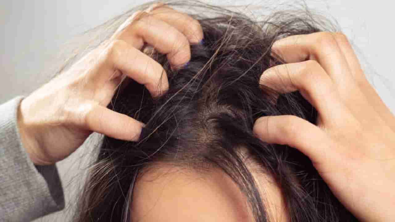 Hair Care Tips: ತಲೆ ವಿಪರೀತ ತುರಿಸುತ್ತದೆಯೇ? ಇಲ್ಲಿದೆ ಪರಿಹಾರ