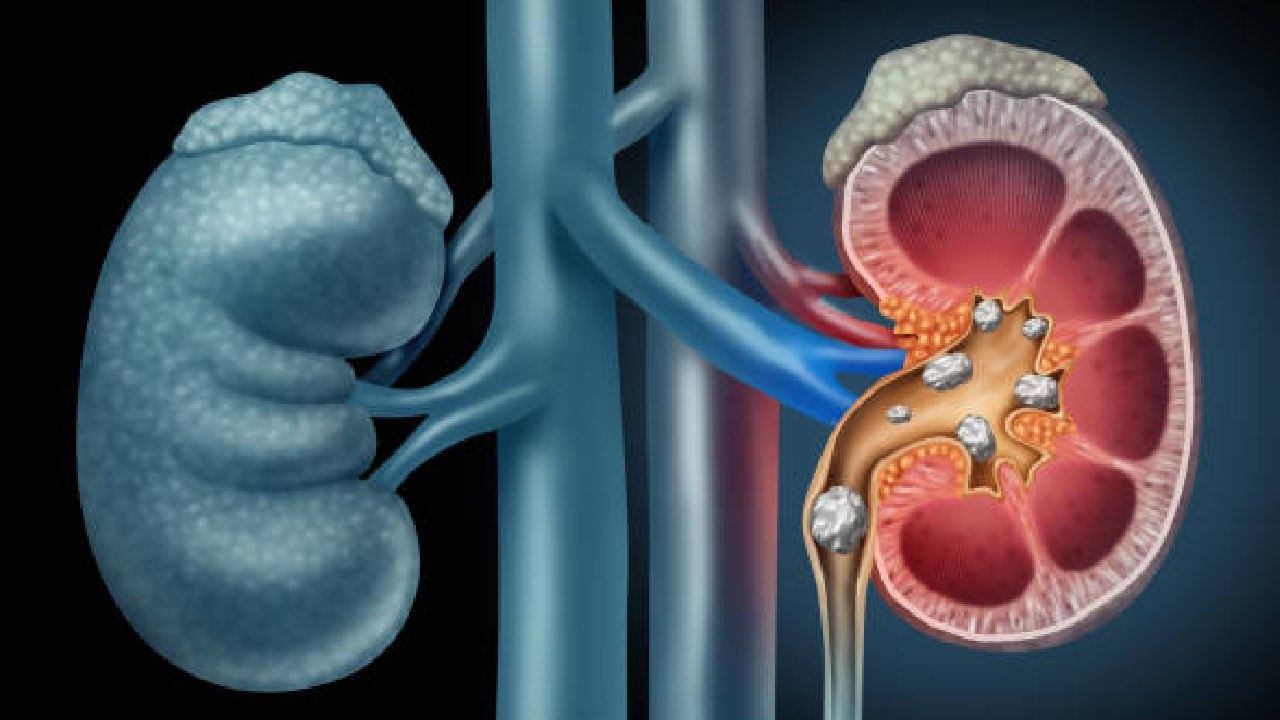 Kidney Stone: ಈ ಲಕ್ಷಣಗಳು ಕಿಡ್ನಿ ಸ್ಟೋನ್ ಸಂಕೇತಗಳಾಗಿರಬಹುದು ಎಚ್ಚರ!