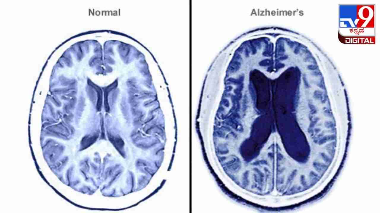 Alzheimer Disease: ಆಲ್ಝೈಮರ್ನ ಕಾಯಿಲೆಯು ಕೂಡ ಒಬ್ಬರಿಂದ ಒಬ್ಬರಿಗೆ ಹರಡಬಹುದು!