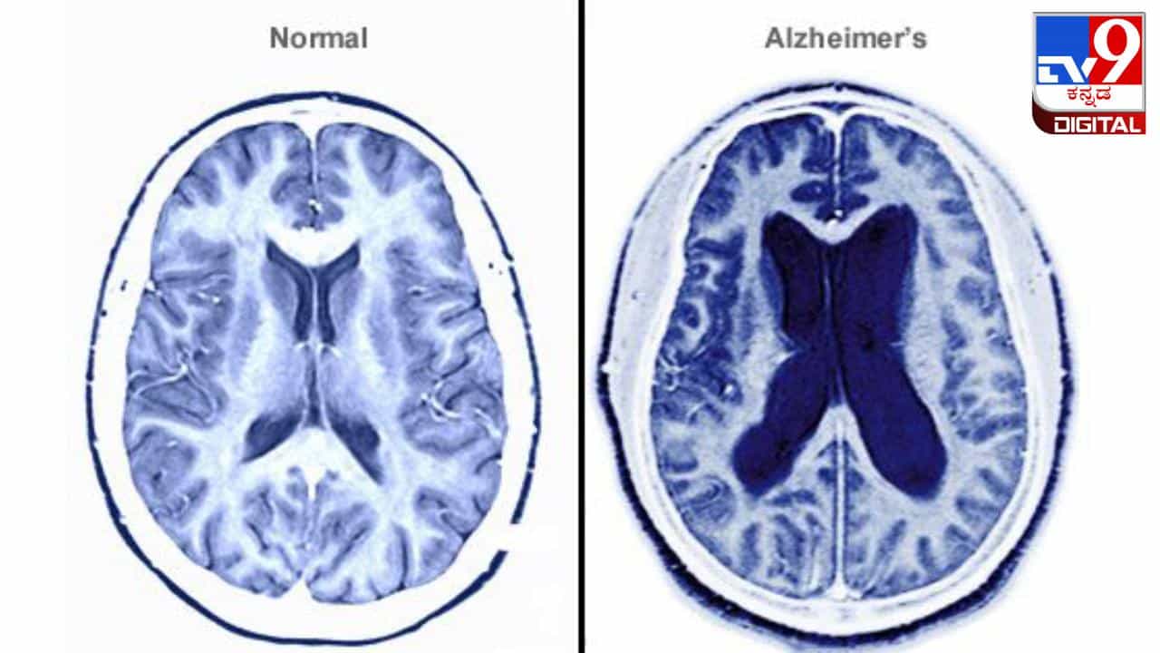 Alzheimer Disease: ಆಲ್ಝೈಮರ್ನ ಕಾಯಿಲೆಯು ಕೂಡ ಒಬ್ಬರಿಂದ ಒಬ್ಬರಿಗೆ ಹರಡಬಹುದು!