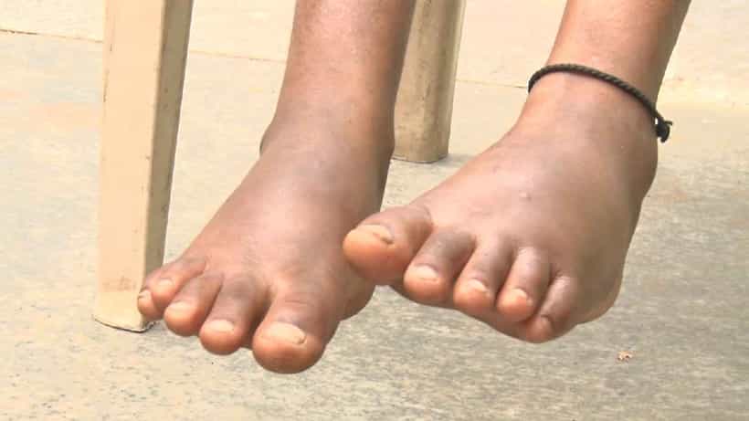 ಕಬ್ಬಿಣ ಕಾಯಿಸಿ ಮೈಮೇಲೆ ಬರೆ ಎಳೆದ ಮಲತಾಯಿ, ನಡೆಯಲು ಆಗದೆ ಪುಟ್ಟ ಬಾಲಕಿ ನರಳಾಟ