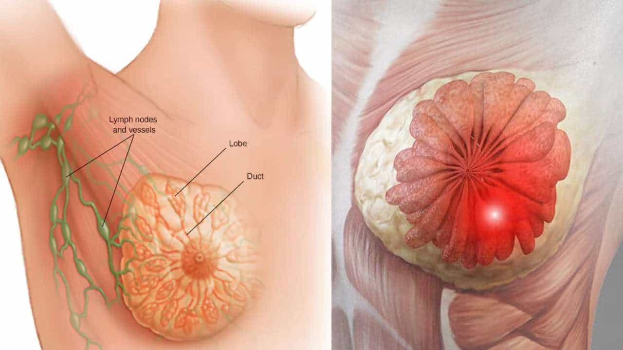 Breast Cancer: ನಿಮ್ಮಲ್ಲಿ ಈ ಲಕ್ಷಣಗಳು ಕಂಡು ಬಂದರೆ ಸ್ತನ ಕ್ಯಾನ್ಸರ್ನ ಲಕ್ಷಣವಾಗಿರಬಹುದು Breast Cancer: ನಿಮ್ಮಲ್ಲಿ ಈ ಲಕ್ಷಣಗಳು ಕಂಡು ಬಂದರೆ ಸ್ತನ ಕ್ಯಾನ್ಸರ್ನ ಲಕ್ಷಣವಾಗಿರಬಹುದು