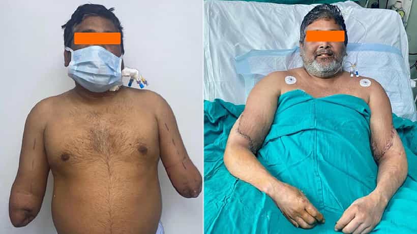 ಅಪಘಾತದಲ್ಲಿ ಎರಡೂ ಕೈ ಕಳೆದುಕೊಂಡಿದ್ದ ಪೇಂಟರ್ಗೆ ಮಹಿಳೆ ಕೈ ಜೋಡಣೆ ಯಶಸ್ವಿ