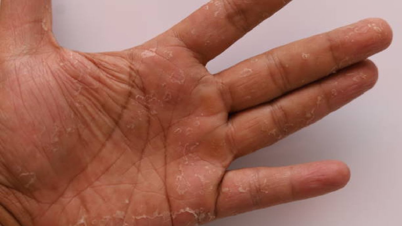 ಆಗಾಗ ಕೈಯಲ್ಲಿ ಸಿಪ್ಪೆ ಸುಲಿಯುತ್ತದೆಯೇ? ಇಲ್ಲಿದೆ ಪರಿಹಾರ ಆಗಾಗ ಕೈಯಲ್ಲಿ ಸಿಪ್ಪೆ ಸುಲಿಯುತ್ತದೆಯೇ? ಇಲ್ಲಿದೆ ಪರಿಹಾರ