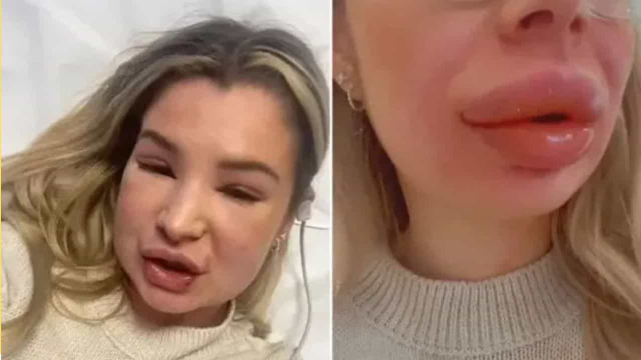 Lip Filler : ತುಟಿಯ ಅಂದ ಹೆಚ್ಚಿಸಲು ಲಿಪ್ ಫಿಲ್ಲರ್ ಚಿಕಿತ್ಸೆಗೊಳಗಾದ ಯುವತಿ, ಮುಂದೇನಾಯಿತು? Lip Filler : ತುಟಿಯ ಅಂದ ಹೆಚ್ಚಿಸಲು ಲಿಪ್ ಫಿಲ್ಲರ್ ಚಿಕಿತ್ಸೆಗೊಳಗಾದ ಯುವತಿ, ಮುಂದೇನಾಯಿತು?