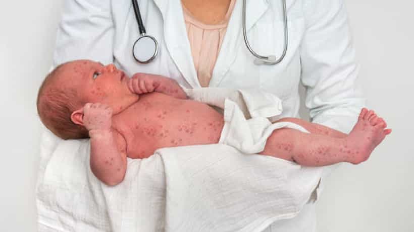 Measles Symptoms: ಮಕ್ಕಳಲ್ಲಿ ದಡಾರದ 7 ಲಕ್ಷಣಗಳಿವು
