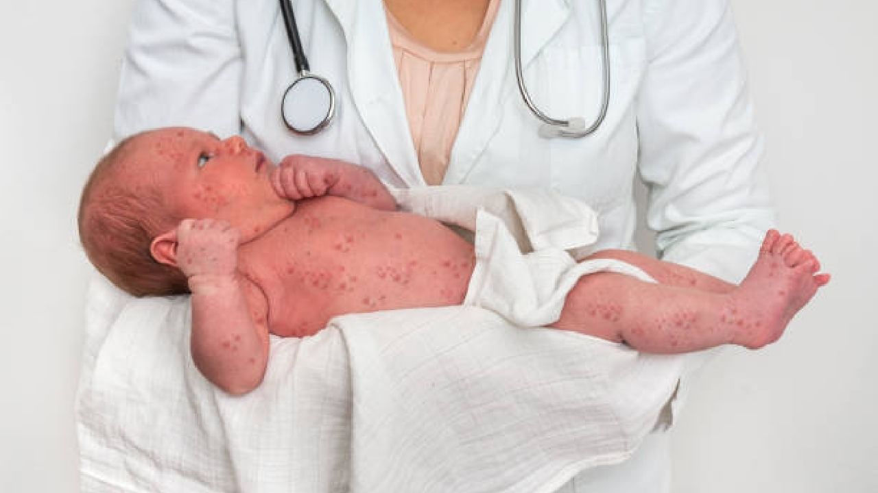 Measles Symptoms: ಮಕ್ಕಳಲ್ಲಿ ದಡಾರದ 7 ಲಕ್ಷಣಗಳಿವು