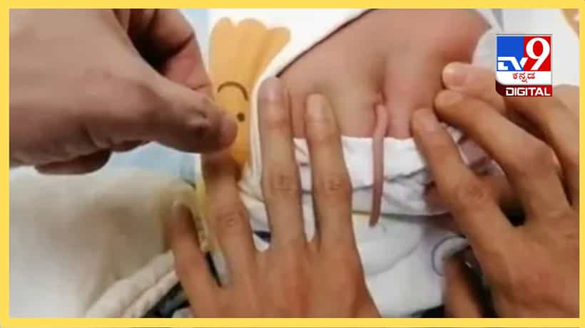Viral: ನಾಲ್ಕು ಇಂಚಿನ ಬಾಲದೊಂದಿಗೆ ಜನಿಸಿದ ಮಗು; ಬೆರಗಾದ ವೈದ್ಯ ಲೋಕ