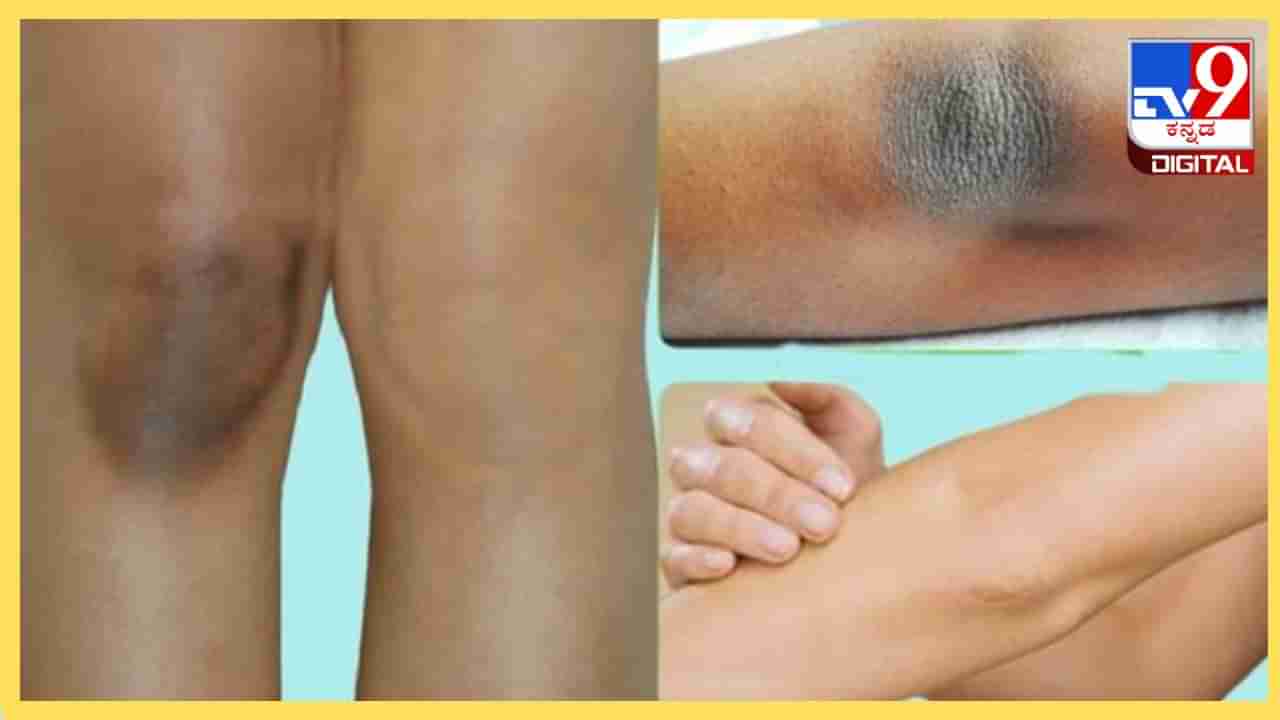 Dark Knees And Elbows : ಮೊಣಕೈ, ಮೊಣಕಾಲಿನ ಕಪ್ಪಾದ ಭಾಗಗಳು ನಿಮ್ಮ ಅಂದಕ್ಕೆ ಕಪ್ಪುಚುಕ್ಕೆ, ಇಲ್ಲಿದೆ ಸರಳ ಮನೆ ಮದ್ದು