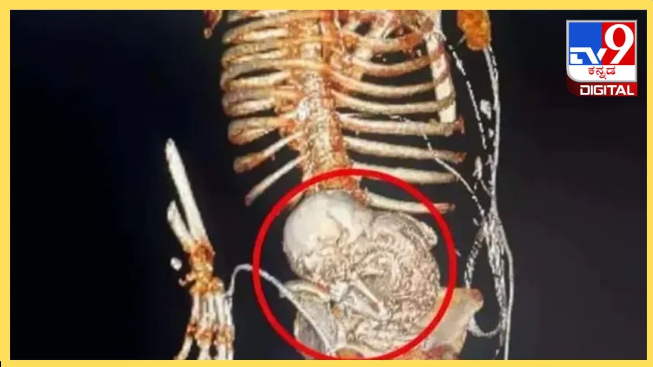 Stone Baby : 81ರ ಹರೆಯದ ವೃದ್ಧೆಯ ಗರ್ಭದಲ್ಲಿ ಕಲ್ಲಿನ ಮಗು, ಏನಿದು ಅಚ್ಚರಿಯ ಸಂಗತಿ! Stone Baby : 81ರ ಹರೆಯದ ವೃದ್ಧೆಯ ಗರ್ಭದಲ್ಲಿ ಕಲ್ಲಿನ ಮಗು, ಏನಿದು ಅಚ್ಚರಿಯ ಸಂಗತಿ!