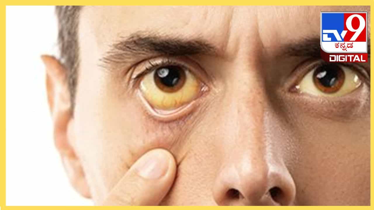 Jaundice : ಕಾಮಾಲೆ ಬಂದರೆ ಆತಂಕ ಬೇಡ, ಶೀಘ್ರವಾಗಿ ಗುಣ ಪಡಿಸಿಕೊಳ್ಳುವುದು ಹೇಗೆ? Jaundice : ಕಾಮಾಲೆ ಬಂದರೆ ಆತಂಕ ಬೇಡ, ಶೀಘ್ರವಾಗಿ ಗುಣ ಪಡಿಸಿಕೊಳ್ಳುವುದು ಹೇಗೆ?