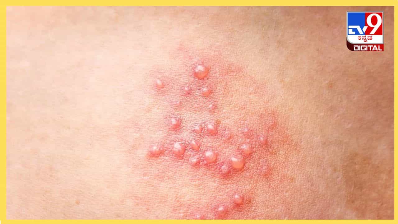 Herpes : ಸರ್ಪಸುತ್ತು ಬಗ್ಗೆ ಆತಂಕ ಬೇಡ, ಇಲ್ಲಿದೆ ಸರಳ ಮನೆ ಮದ್ದುಗಳು Herpes : ಸರ್ಪಸುತ್ತು ಬಗ್ಗೆ ಆತಂಕ ಬೇಡ, ಇಲ್ಲಿದೆ ಸರಳ ಮನೆ ಮದ್ದುಗಳು