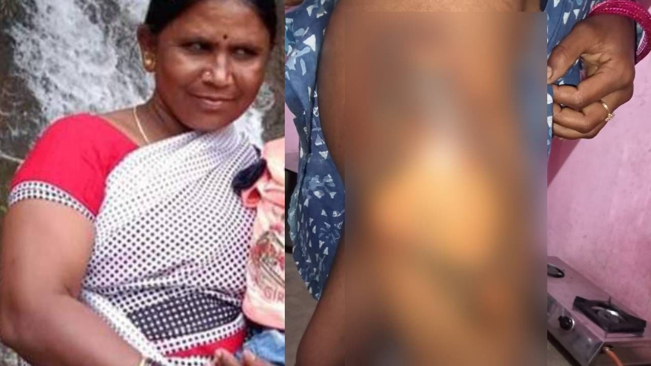 ತುಮಕೂರು: ಬ್ಯಾಂಕ್ನಲ್ಲಿದ್ದ ಹಣಕ್ಕಾಗಿ ಇಸ್ತ್ರಿ ಪೆಟ್ಟಿಗೆಯಿಂದ ಮಗಳ ತೊಡೆ ಸುಟ್ಟ ದೊಡ್ಡಮ್ಮ