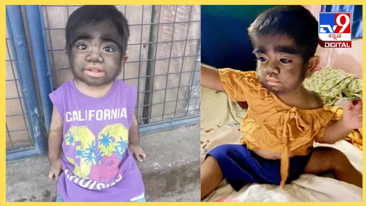 Viral: ಮಗು ಹೀಗೆ ಹುಟ್ಟಲು ಗರ್ಭಿಣಿಯಾಗಿದ್ದಾಗ ನಾನು ಬೆಕ್ಕಿನ ಮಾಂಸ ತಿಂದಿದ್ದೆ ಕಾರಣ ಎಂದ ತಾಯಿ Viral: ಮಗು ಹೀಗೆ ಹುಟ್ಟಲು ಗರ್ಭಿಣಿಯಾಗಿದ್ದಾಗ ನಾನು ಬೆಕ್ಕಿನ ಮಾಂಸ ತಿಂದಿದ್ದೆ ಕಾರಣ ಎಂದ ತಾಯಿ