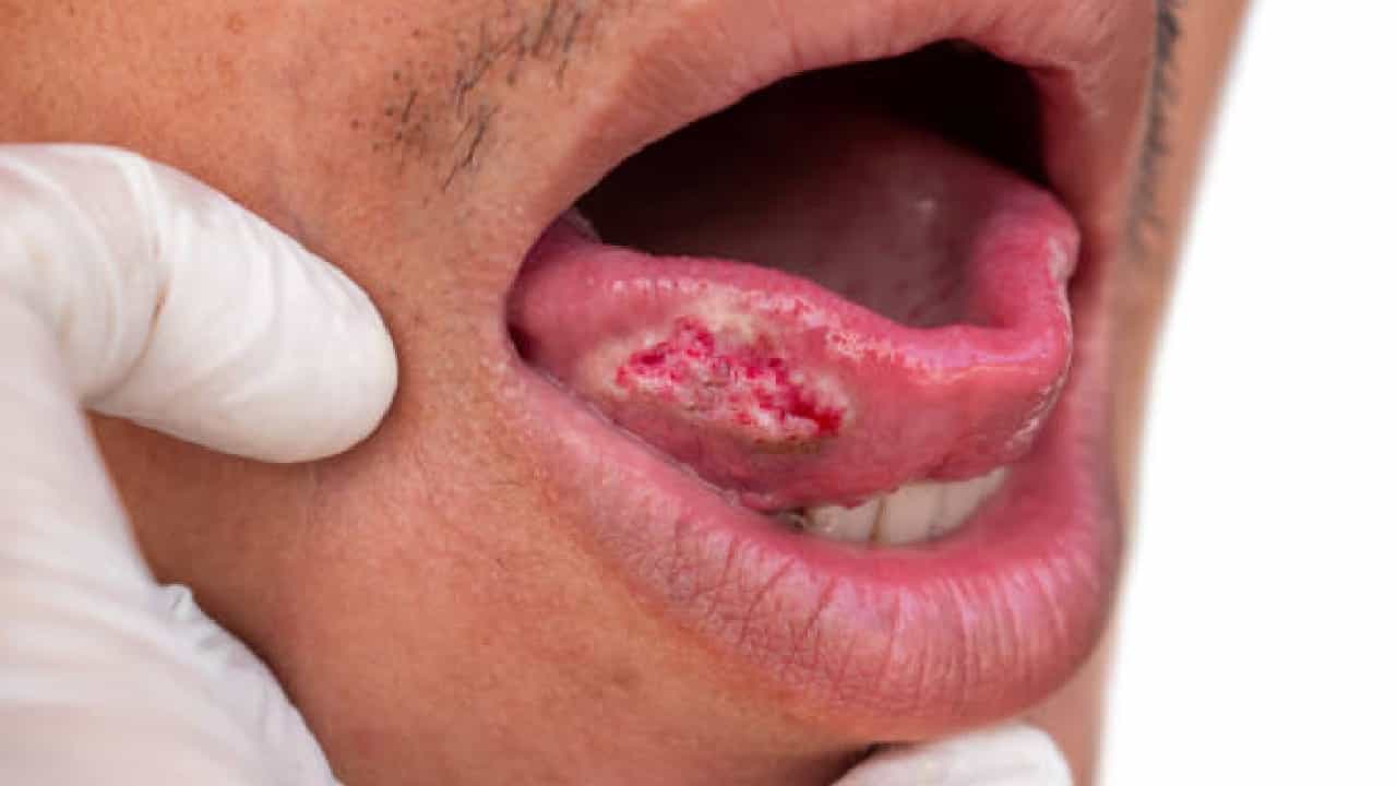 Oral Cancer: ಬಾಯಿಯ ಕ್ಯಾನ್ಸರ್ನ ಈ 8 ಆರಂಭಿಕ ಲಕ್ಷಣಗಳನ್ನು ನಿರ್ಲಕ್ಷ್ಯಿಸಬೇಡಿ Oral Cancer: ಬಾಯಿಯ ಕ್ಯಾನ್ಸರ್ನ ಈ 8 ಆರಂಭಿಕ ಲಕ್ಷಣಗಳನ್ನು ನಿರ್ಲಕ್ಷ್ಯಿಸಬೇಡಿ