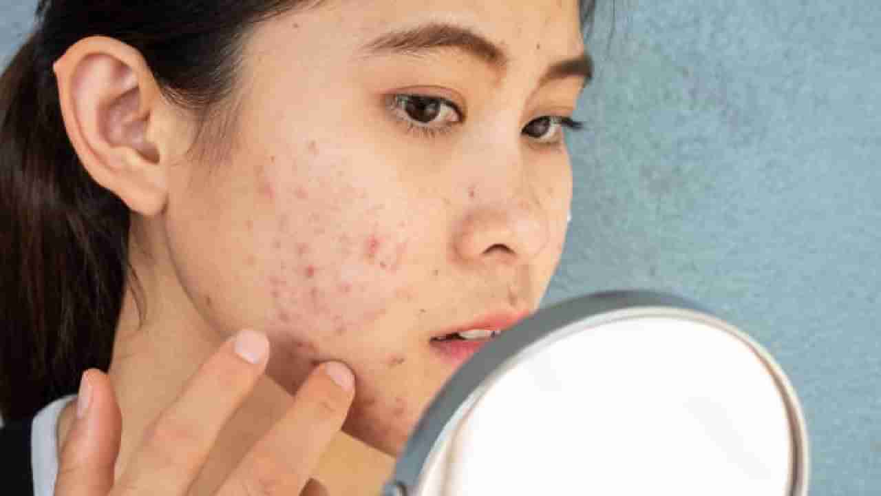 Acne Control: ಮೊಡವೆಗಳಿಂದ ಬೇಸತ್ತಿದ್ದೀರಾ?; ಹೊಳೆಯುವ ತ್ವಚೆ ಪಡೆಯಲು ಈ ಡಯೆಟ್ ಅನುಸರಿಸಿ