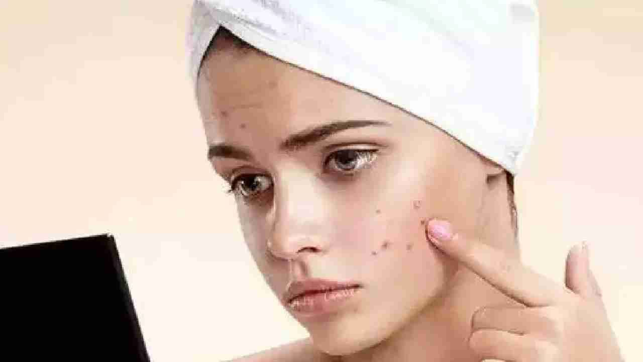 Beauty Care Tips in Kannada: ಮೊಡವೆ ಕಲೆಗಳು ನಿಮ್ಮ ಮುಖದ ಅಂದವನ್ನು ಹಾಳು ಮಾಡುತ್ತಿವೆಯೇ? ಇಲ್ಲಿದೆ ಸರಳ ಮನೆಮದ್ದು