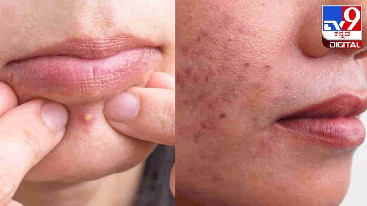 Get Rid of Pimples: ಮೊಡವೆ ಸಮಸ್ಯೆಯಿಂದ ಬಳಲುತ್ತಿದ್ದರೆ ಈ  ಒಂದು ಎಲೆ ಬಳಸಿ