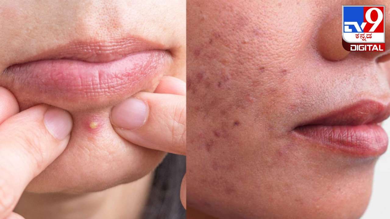 Get Rid of Pimples: ಮೊಡವೆ ಸಮಸ್ಯೆಯಿಂದ ಬಳಲುತ್ತಿದ್ದರೆ ಈ  ಒಂದು ಎಲೆ ಬಳಸಿ