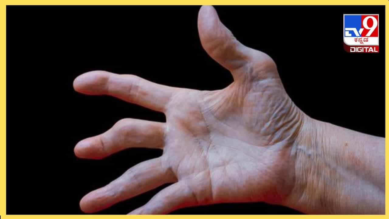 Rheumatoid arthritis: ಧೂಮಪಾನ ರುಮಟಾಯ್ಡ್ ಸಂಧಿವಾತಕ್ಕೆ ಕಾರಣವಾಗಬಹುದೇ? ವೈದ್ಯರು ಹೇಳುವುದೇನು? Rheumatoid arthritis: ಧೂಮಪಾನ ರುಮಟಾಯ್ಡ್ ಸಂಧಿವಾತಕ್ಕೆ ಕಾರಣವಾಗಬಹುದೇ? ವೈದ್ಯರು ಹೇಳುವುದೇನು?