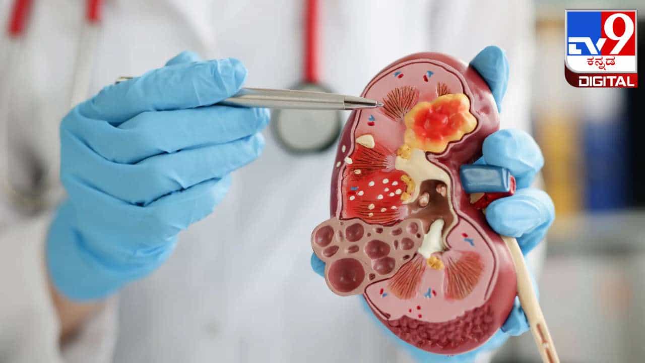 Kidney Stone: ಕಿಡ್ನಿ ಸ್ಟೋನ್ ಜಾಸ್ತಿಯಾಗುತ್ತಿರುವುದೇಕೆ? ತಜ್ಞರು ಹೇಳುವುದೇನು? Kidney Stone: ಕಿಡ್ನಿ ಸ್ಟೋನ್ ಜಾಸ್ತಿಯಾಗುತ್ತಿರುವುದೇಕೆ? ತಜ್ಞರು ಹೇಳುವುದೇನು?