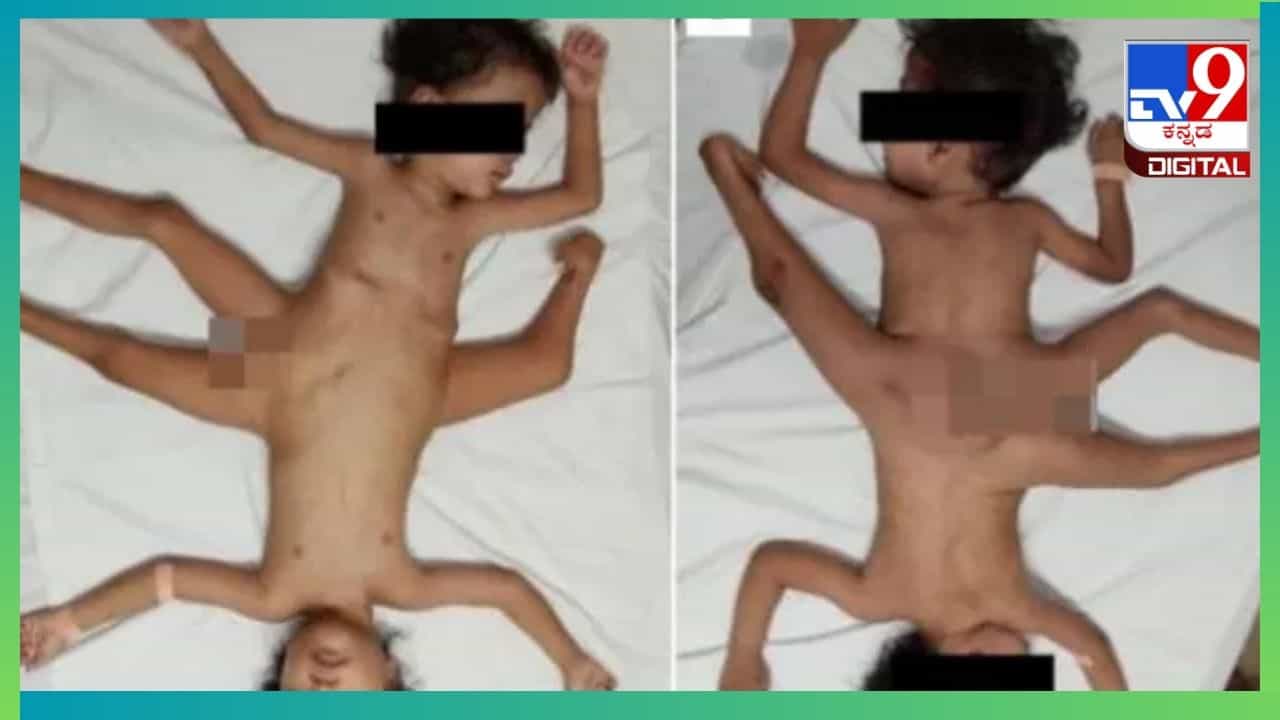 Viral: ಒಂದು ದೇಹ ಎರಡು ಜೀವ; ಮೂರು ಕಾಲು, ನಾಲ್ಕು ಕೈ, ಒಂದು ಶಿಶ್ನ ಸಯಾಮಿ ಅವಳಿ ಮಕ್ಕಳ ಜನನ Viral: ಒಂದು ದೇಹ ಎರಡು ಜೀವ; ಮೂರು ಕಾಲು, ನಾಲ್ಕು ಕೈ, ಒಂದು ಶಿಶ್ನ ಸಯಾಮಿ ಅವಳಿ ಮಕ್ಕಳ ಜನನ