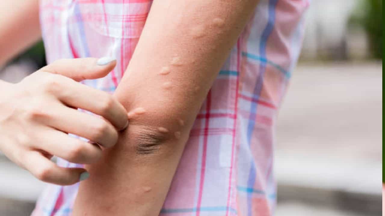 West Nile Fever: ವೆಸ್ಟ್ ನೈಲ್ ಜ್ವರದ ಲಕ್ಷಣಗಳೇನು?; ಇದನ್ನು ತಡೆಗಟ್ಟೋದು ಹೇಗೆ? West Nile Fever: ವೆಸ್ಟ್ ನೈಲ್ ಜ್ವರದ ಲಕ್ಷಣಗಳೇನು?; ಇದನ್ನು ತಡೆಗಟ್ಟೋದು ಹೇಗೆ?