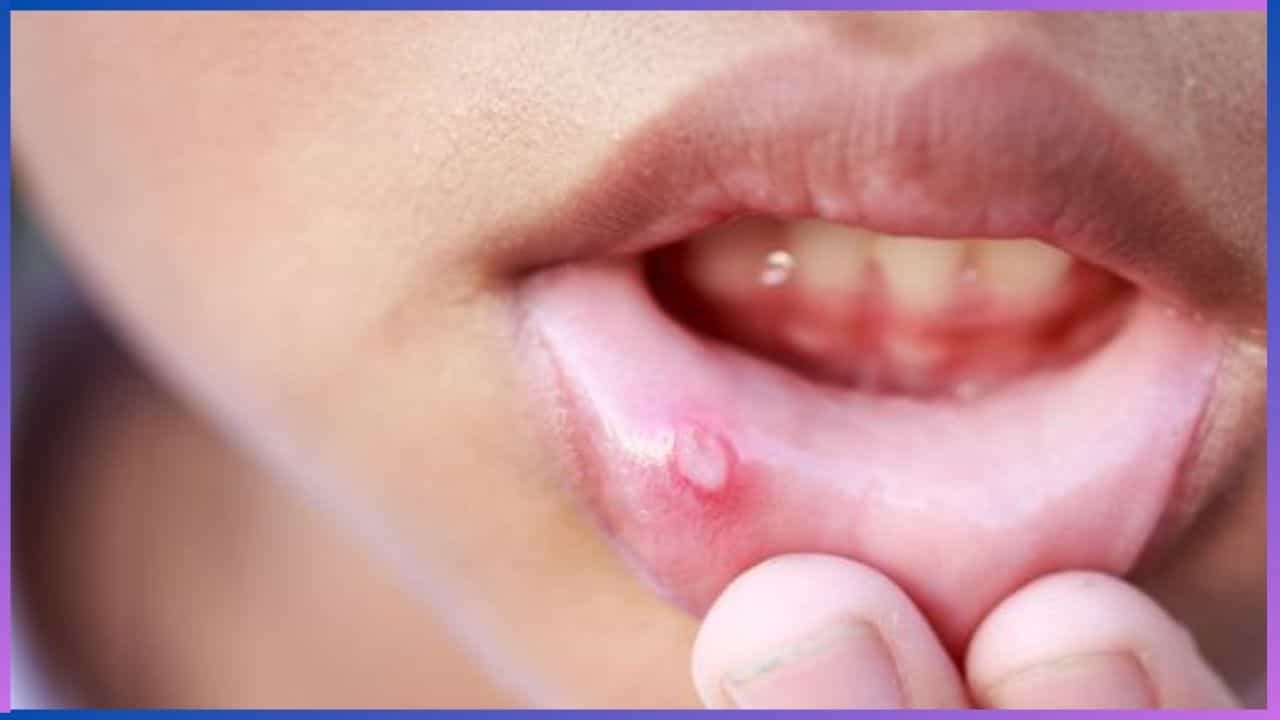 Health Tips: ಒಂದೇ ದಿನದಲ್ಲಿ ಬಾಯಿ ಹುಣ್ಣಿನಿಂದ ಮುಕ್ತಿ, ಈ ಮನೆಮದ್ದು ಟ್ರೈ ಮಾಡಿ Health Tips: ಒಂದೇ ದಿನದಲ್ಲಿ ಬಾಯಿ ಹುಣ್ಣಿನಿಂದ ಮುಕ್ತಿ, ಈ ಮನೆಮದ್ದು ಟ್ರೈ ಮಾಡಿ