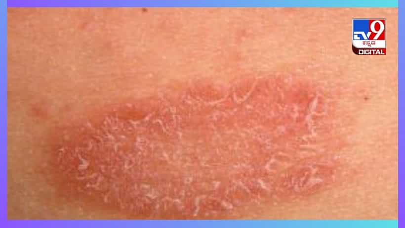 Ringworm: ರಿಂಗ್ವರ್ಮ್ ಸಮಸ್ಯೆಗೆ ತೆಂಗಿನ ಎಣ್ಣೆಯೇ ಮದ್ದು
