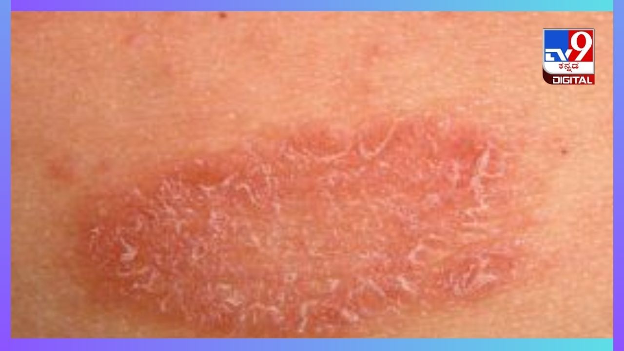 Ringworm: ರಿಂಗ್ವರ್ಮ್ ಸಮಸ್ಯೆಗೆ ತೆಂಗಿನ ಎಣ್ಣೆಯೇ ಮದ್ದು Ringworm: ರಿಂಗ್ವರ್ಮ್ ಸಮಸ್ಯೆಗೆ ತೆಂಗಿನ ಎಣ್ಣೆಯೇ ಮದ್ದು