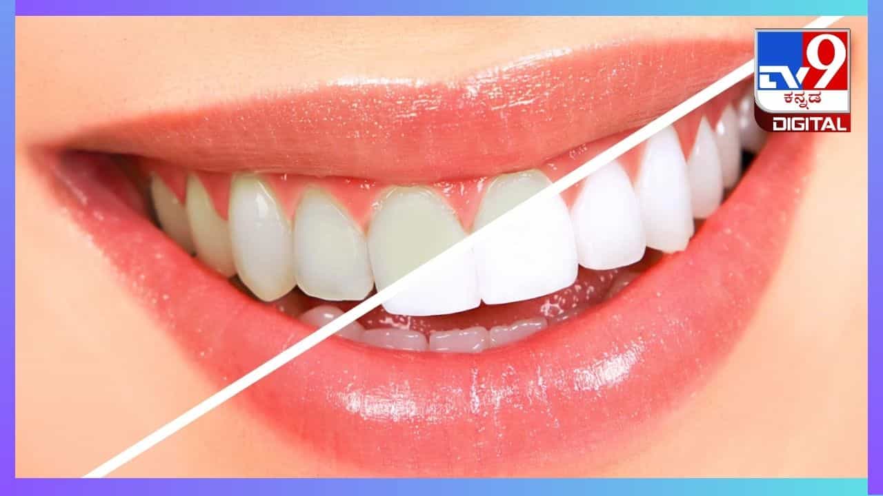 Teeth Whitening Tips: ಹಲ್ಲುಗಳು ಹಳದಿಗಟ್ಟಿದ್ದರೆ ಫಳಫಳ ಹೊಳೆಯುವಂತೆ ಮಾಡುವುದು ಹೇಗೆ? ಇಲ್ಲಿದೆ ಮನೆಮದ್ದು Teeth Whitening Tips: ಹಲ್ಲುಗಳು ಹಳದಿಗಟ್ಟಿದ್ದರೆ ಫಳಫಳ ಹೊಳೆಯುವಂತೆ ಮಾಡುವುದು ಹೇಗೆ? ಇಲ್ಲಿದೆ ಮನೆಮದ್ದು