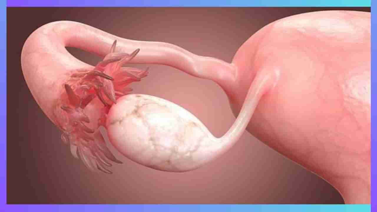 Ovarian Cancer: ಮಹಿಳೆಯರೇ ನಿಮ್ಮಲ್ಲಿ ಈ ರೋಗಲಕ್ಷಣ ಕಂಡುಬಂದರೆ ಅಂಡಾಶಯದ ಕ್ಯಾನ್ಸರ್ ಆಗಿರಬಹುದು