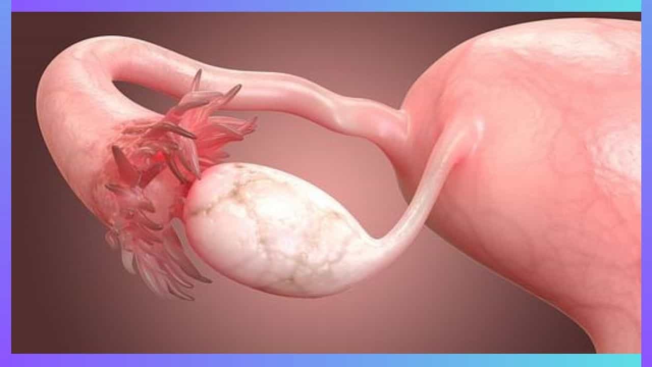 Ovarian Cancer: ಮಹಿಳೆಯರೇ ನಿಮ್ಮಲ್ಲಿ ಈ ರೋಗಲಕ್ಷಣ ಕಂಡುಬಂದರೆ ಅಂಡಾಶಯದ ಕ್ಯಾನ್ಸರ್ ಆಗಿರಬಹುದು Ovarian Cancer: ಮಹಿಳೆಯರೇ ನಿಮ್ಮಲ್ಲಿ ಈ ರೋಗಲಕ್ಷಣ ಕಂಡುಬಂದರೆ ಅಂಡಾಶಯದ ಕ್ಯಾನ್ಸರ್ ಆಗಿರಬಹುದು