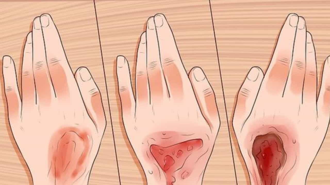 Burn Injury : ಅಡುಗೆ ಮಾಡುವಾಗ ಕೈ ಸುಟ್ಟುಕೊಂಡರೆ, ಈ ವಸ್ತುಗಳೇ ನಿಮಗೆ ಆಪತ್ಪಾಂಧವ Burn Injury : ಅಡುಗೆ ಮಾಡುವಾಗ ಕೈ ಸುಟ್ಟುಕೊಂಡರೆ, ಈ ವಸ್ತುಗಳೇ ನಿಮಗೆ ಆಪತ್ಪಾಂಧವ