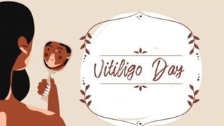 World Vitiligo Day 2024 : ತೊನ್ನು ರೋಗ ಪೂರ್ವ ಜನ್ಮದ ಶಾಪವಲ್ಲ, ಚಿಕಿತ್ಸೆ ನೀಡಿದರೆ ಗುಣಮುಖ ಸಾಧ್ಯ