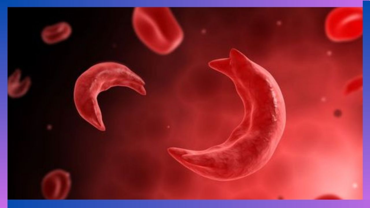 World Sickle Cell Awareness Day 2024 : ಸಿಕಲ್ ಸೆಲ್ ಕಾಯಿಲೆಯ ರೋಗಲಕ್ಷಣಗಳೇನು? ಚಿಕಿತ್ಸೆ ಹೇಗೆ? World Sickle Cell Awareness Day 2024 : ಸಿಕಲ್ ಸೆಲ್ ಕಾಯಿಲೆಯ ರೋಗಲಕ್ಷಣಗಳೇನು? ಚಿಕಿತ್ಸೆ ಹೇಗೆ?