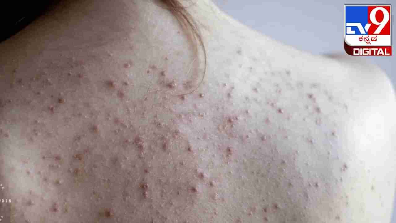 Back Acne : ಬೆನ್ನಿನ ಮೇಲೆ ಮೊಡವೆಗಳಿದ್ದರೆ ಟೆನ್ಶನ್ ಬೇಡ, ಇಲ್ಲಿದೆ ಸರಳ ಪರಿಹಾರ