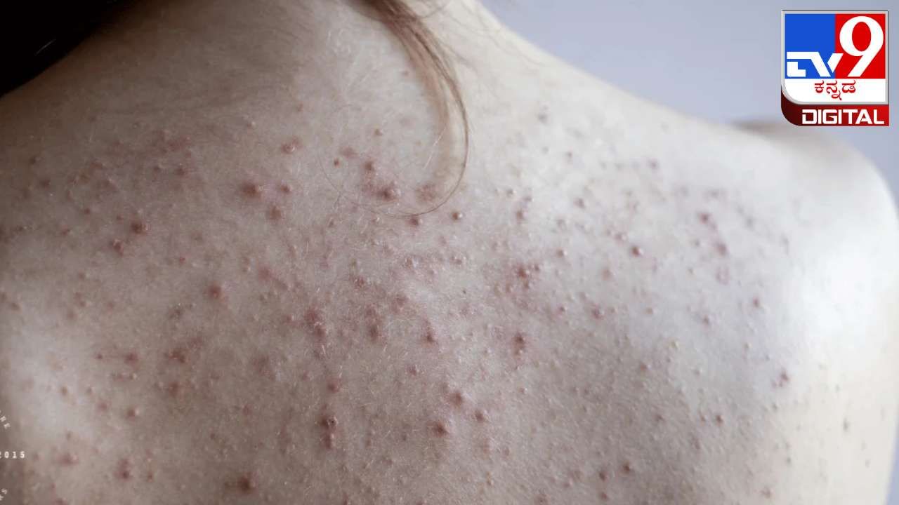 Back Acne : ಬೆನ್ನಿನ ಮೇಲೆ ಮೊಡವೆಗಳಿದ್ದರೆ ಟೆನ್ಶನ್ ಬೇಡ, ಇಲ್ಲಿದೆ ಸರಳ ಪರಿಹಾರ