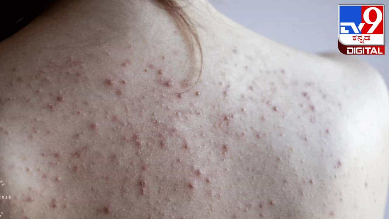 Back Acne : ಬೆನ್ನಿನ ಮೇಲೆ ಮೊಡವೆಗಳಿದ್ದರೆ ಟೆನ್ಶನ್ ಬೇಡ, ಇಲ್ಲಿದೆ ಸರಳ ಪರಿಹಾರ Back Acne : ಬೆನ್ನಿನ ಮೇಲೆ ಮೊಡವೆಗಳಿದ್ದರೆ ಟೆನ್ಶನ್ ಬೇಡ, ಇಲ್ಲಿದೆ ಸರಳ ಪರಿಹಾರ