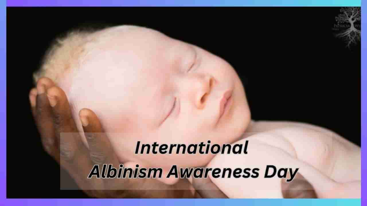 International Albinism Awareness Day 2024 : ಆಲ್ಬಿನಿಸಂ ಬಗ್ಗೆ ತಪ್ಪು ಕಲ್ಪನೆ ಬೇಡ, ರೋಗದ ಬಗ್ಗೆ ಇರಲಿ ಅರಿವು