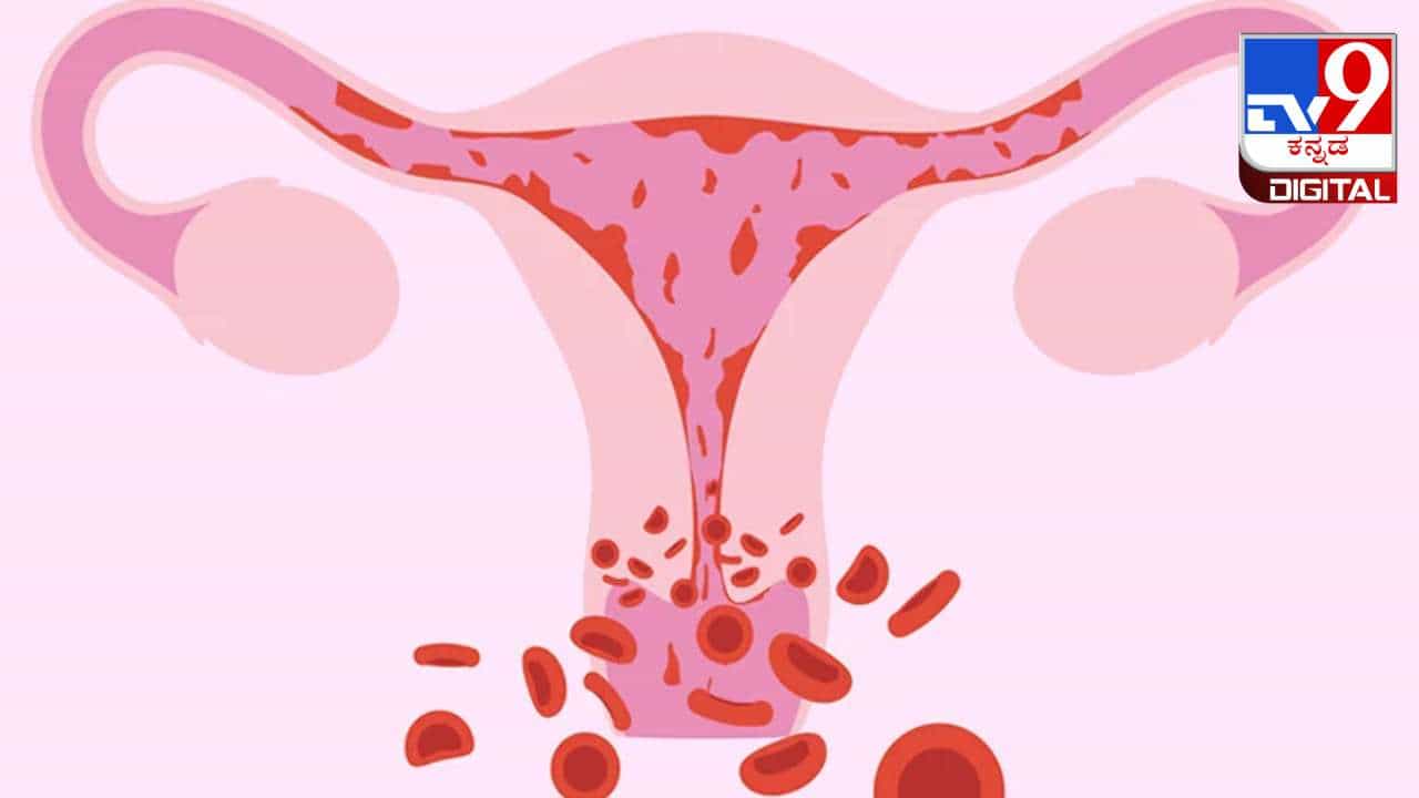 Women Health: ಮುಟ್ಟಿನ ಸಮಯದಲ್ಲಿ ಅತಿಯಾಗಿ ರಕ್ತಸ್ರಾವ ಆಗ್ತಿದ್ಯಾ? ಕಾರಣ ಇಲ್ಲಿ ತಿಳಿದುಕೊಳ್ಳಿ