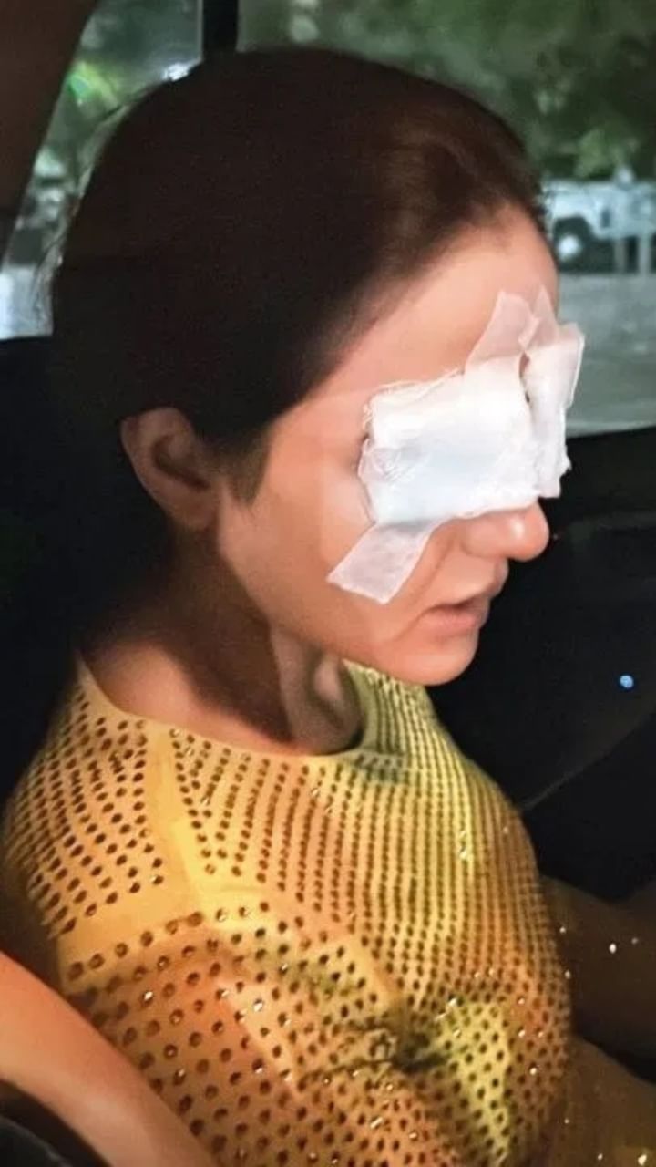 ಕಾಂಟ್ಯಾಕ್ಟ್ ಲೆನ್ಸ್​ನಿಂದ ಕಣ್ಣಿಗೆ ಹಾನಿ ಆಗಿದೆ ಎಂದು ನಟಿ ಜಾಸ್ಮಿನ್ ಭಾಸಿನ್ ಅವರು ಹೇಳಿಕೊಂಡಿದ್ದಾರೆ.