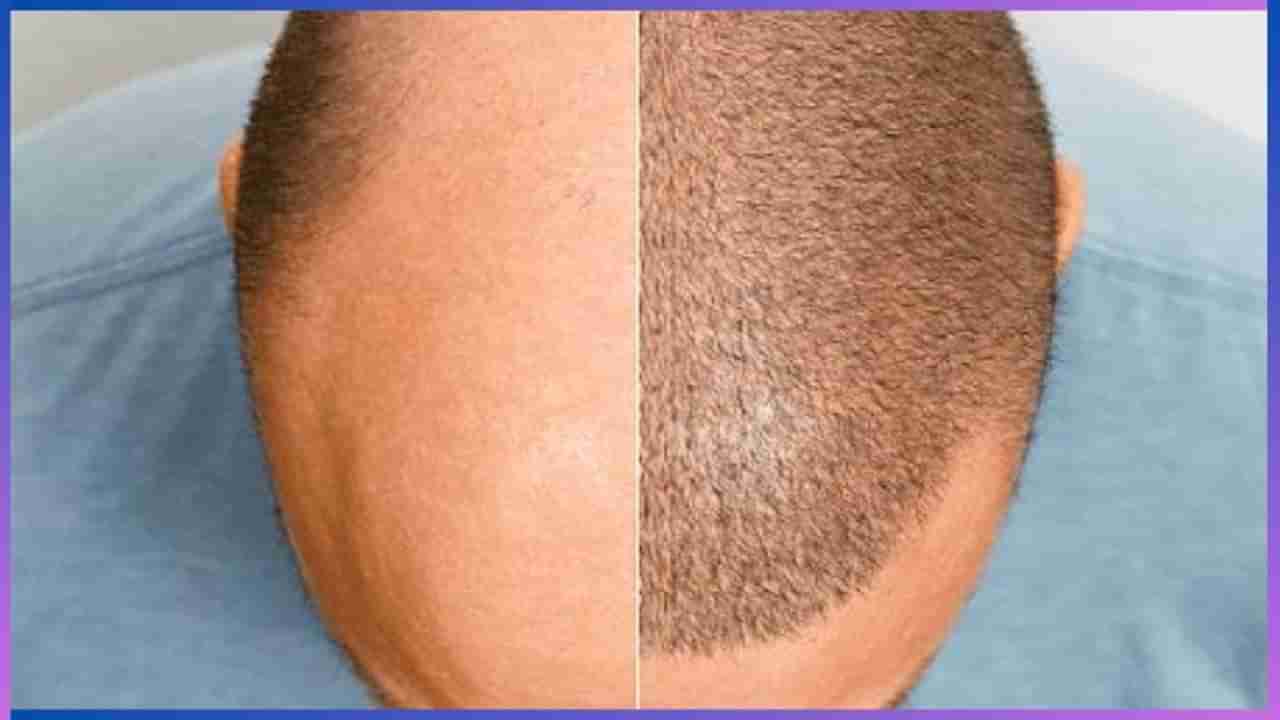 Hair Transplant: ಕೂದಲು ಉದುರುವ ಸಮಸ್ಯೆಗೊಂದು ಶಾಶ್ವತ ಪರಿಹಾರ, ಕೂದಲು ಕಸಿ ವಿಧಾನ